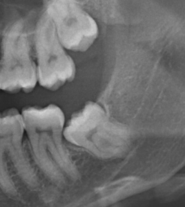 Dente del giudizio mal posizionato in inclusione ossea dente del giudizio mal posizionato in inclusione ossea