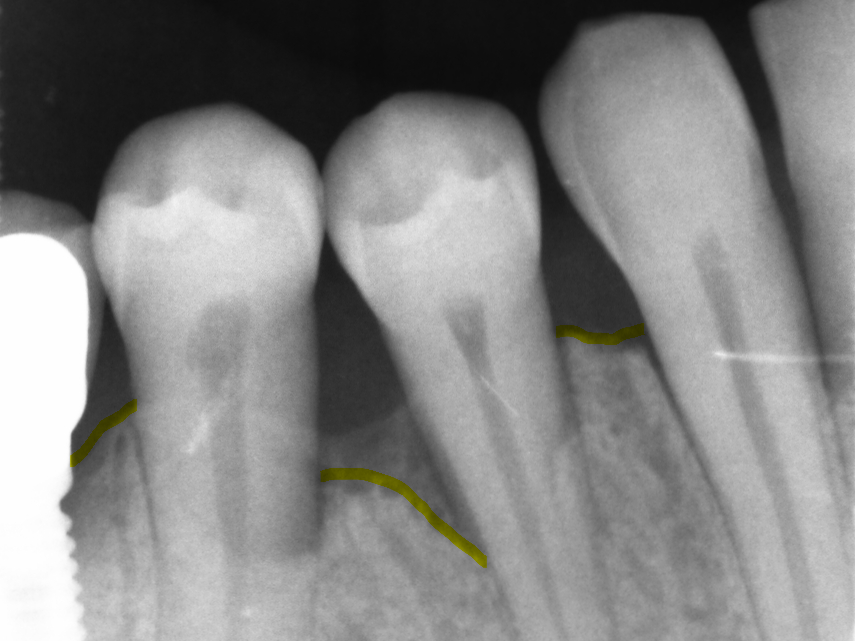 perdita di osso tra due denti